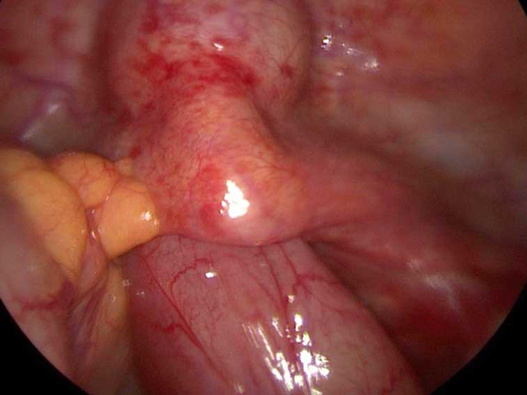 Loop of ileum