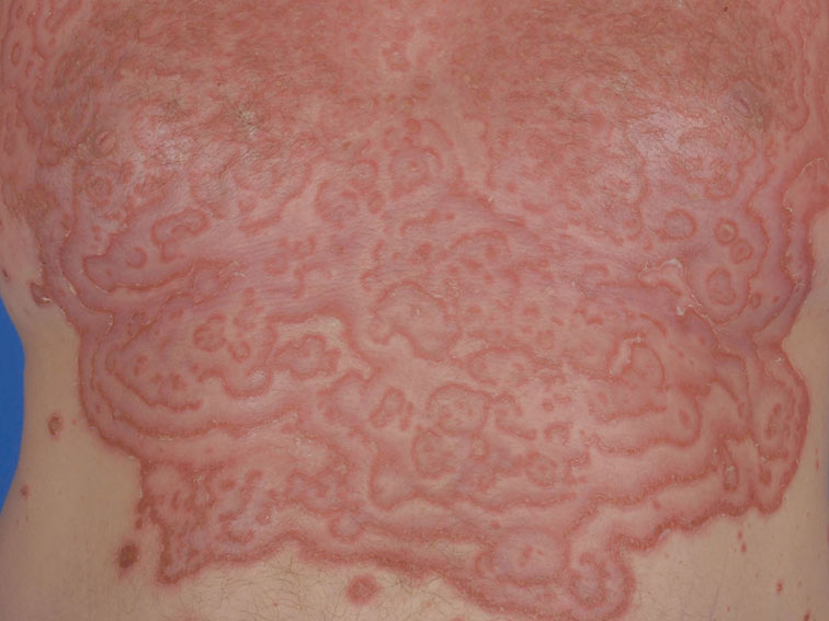 Erythema gyrated repens