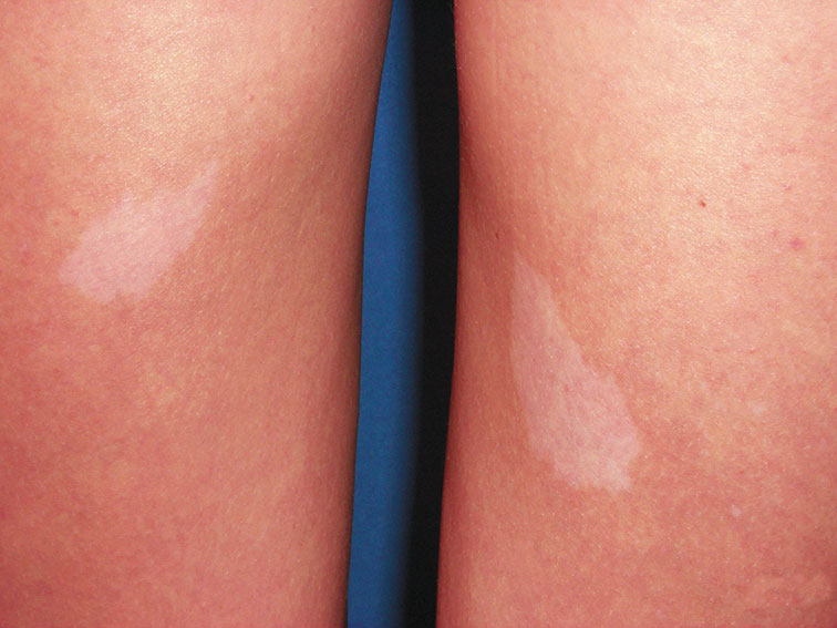 Tuberous Sclerosis