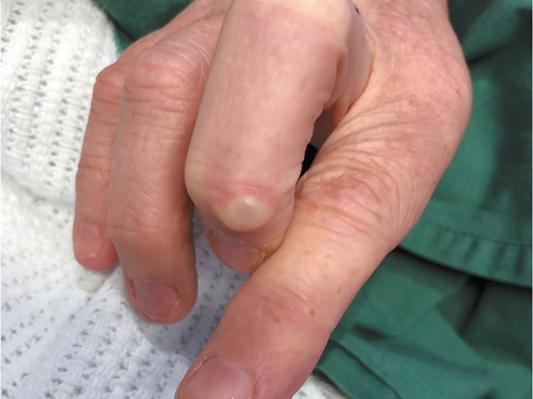 Osteoarthritis thumbs fingers