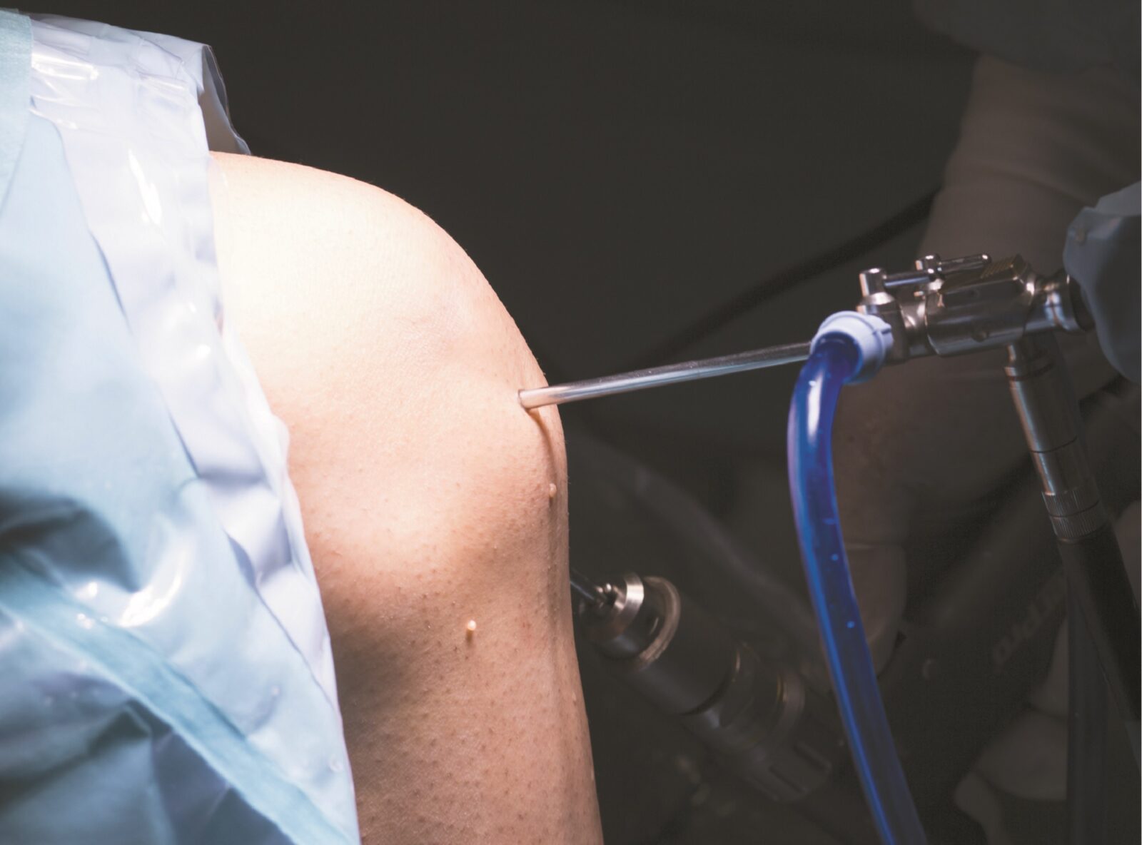 knee arthroscopy