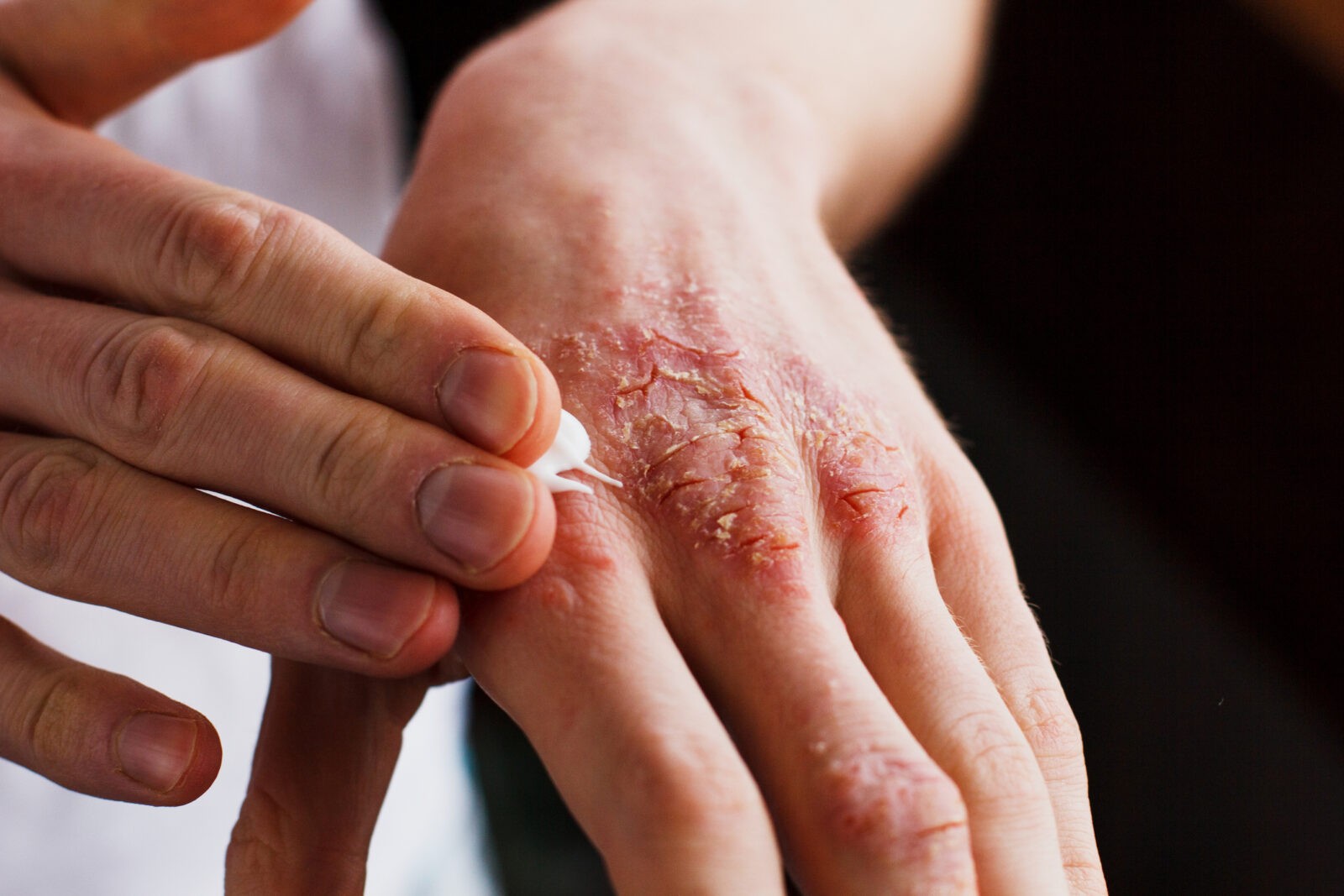 Rubbing cream on hands
