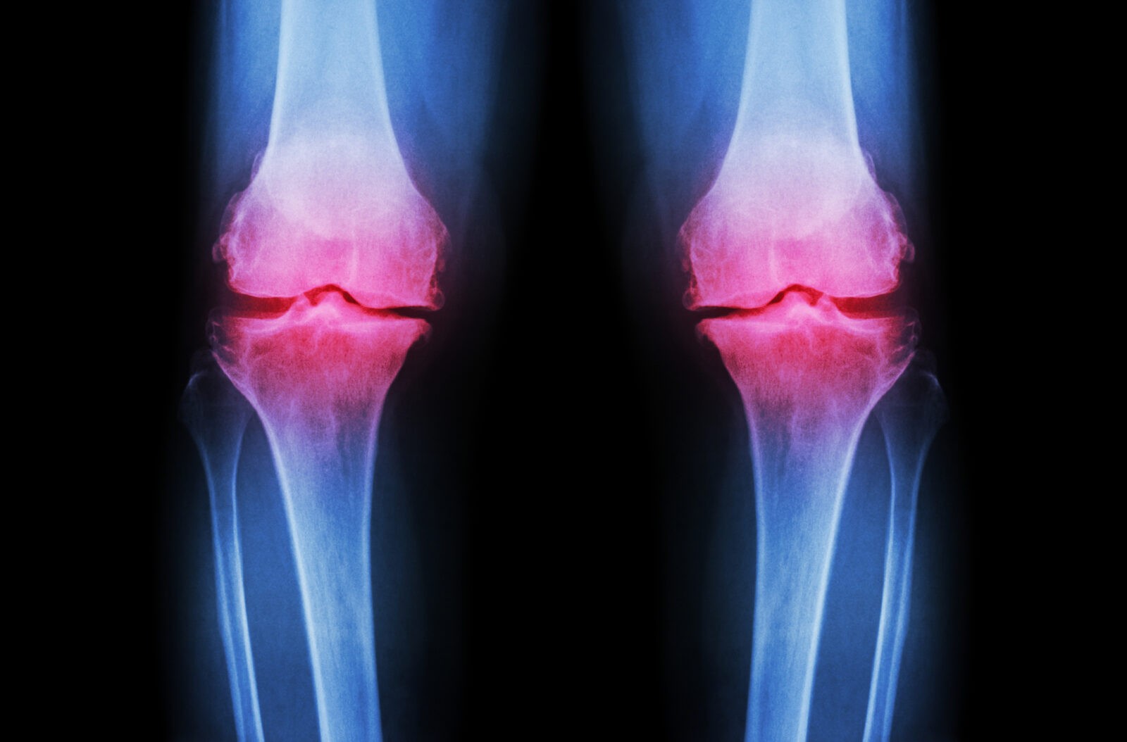 knee surgery