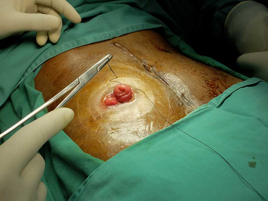 ileostomy