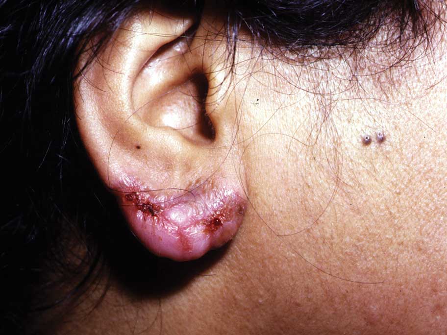 lupus vulgaris