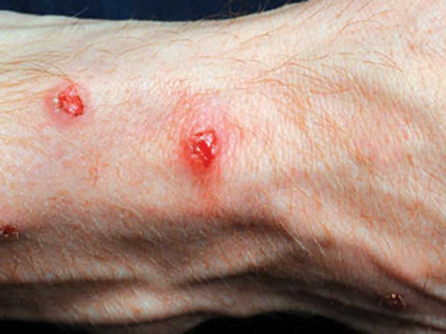 wrist sores