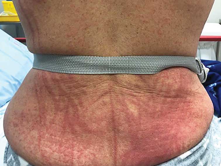 dermatitis
