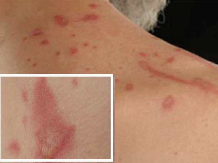 rash on chest