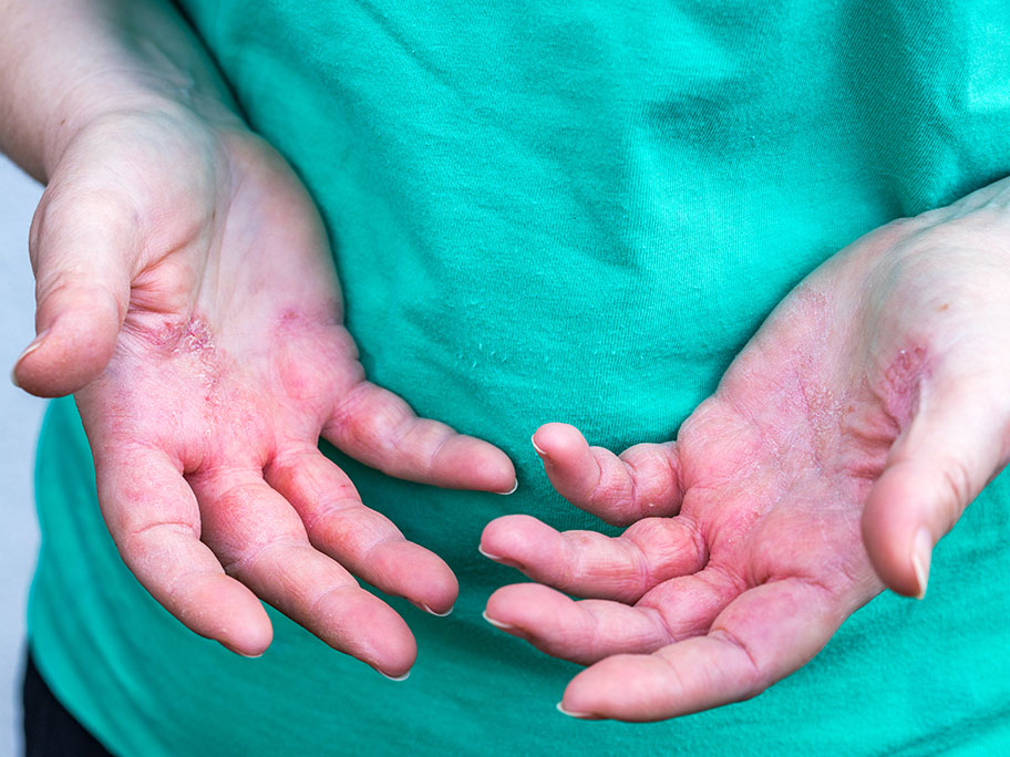 Help is at hand for this persistent palmar rash | AusDoc
