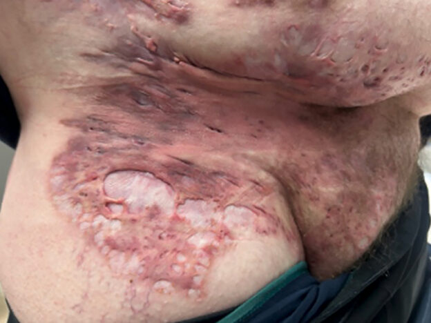 Hidradenitis suppurativa – Hurley stage 3.
