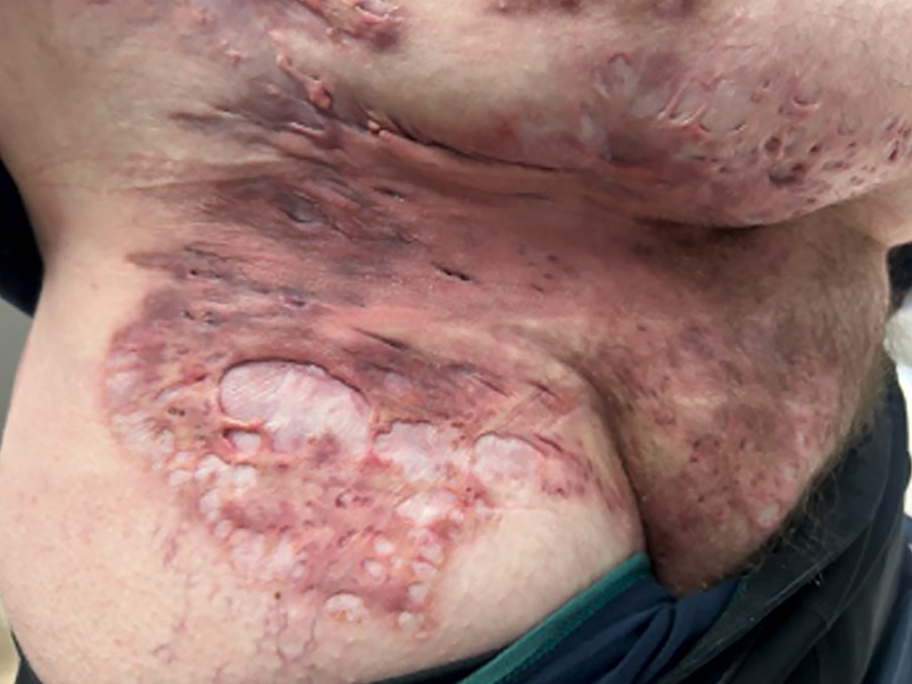 Hidradenitis suppurativa – Hurley stage 3.